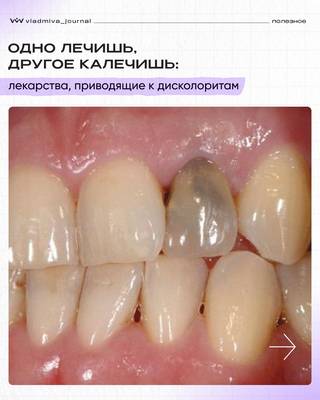 Дисколорит эмали: лекарства, меняющие цвет зубов.